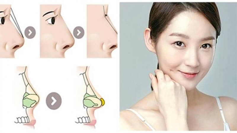 Nâng mũi cấu trúc, bí quyết cho mũi đẹp tự nhiên ở mọi góc nhìn