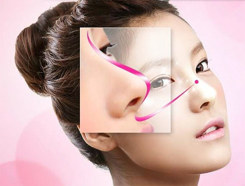 Mỗi phương pháp làm đẹp sẽ có những chất liệu nâng mũi khác nhau
