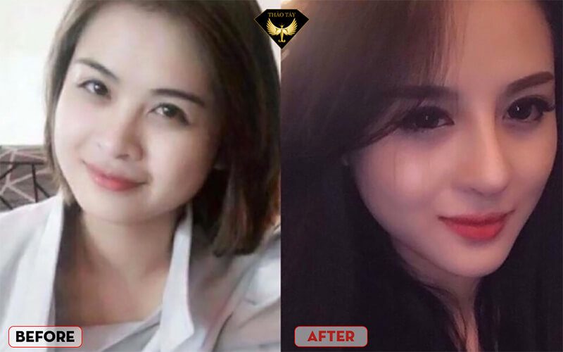 Nâng mũi cấu trúc giúp bạn tự tin tỏa sáng hơn khi giao tiếp