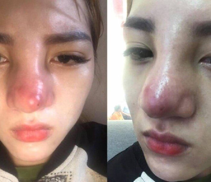 Những dấu hiệu nhiễm trùng sau khi nâng mũi và phương án khắc phục
