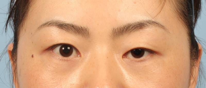 Mắt một mí thường khiến cho đôi mắt nhỏ và có cảm giác luôn u sầu mệt mỏi