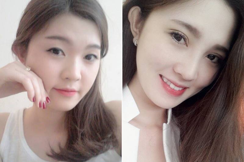 Trước và sau cắt mí mắt