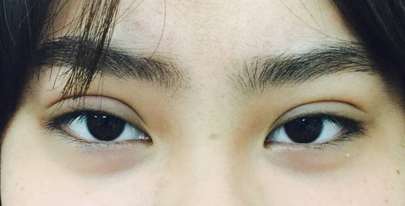 Hình ảnh sau khi cắt mí mắt