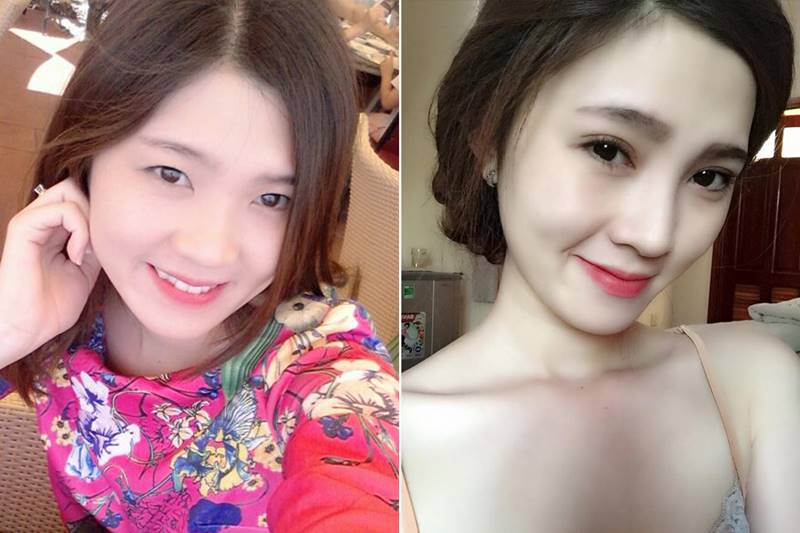 Hình ảnh trước và sau bấm mí mắt
