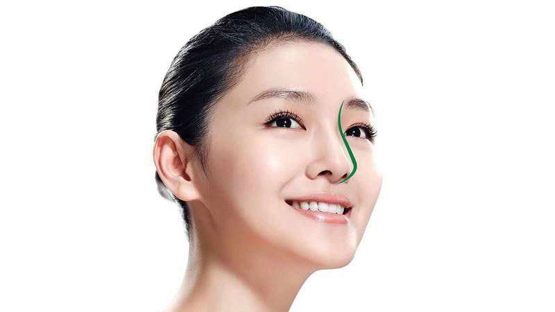 Nâng mũi S line mang đến kết quả đẹp tự nhiên