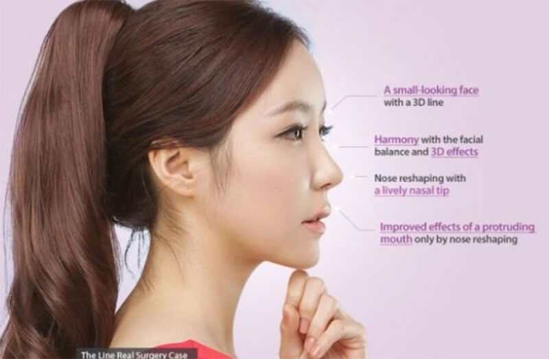 Bạn có biết nâng mũi S line là gì không?