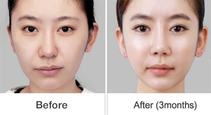 Mọi người có thể yên tâm về một chiếc mũi đẹp tự nhiên và an toàn.