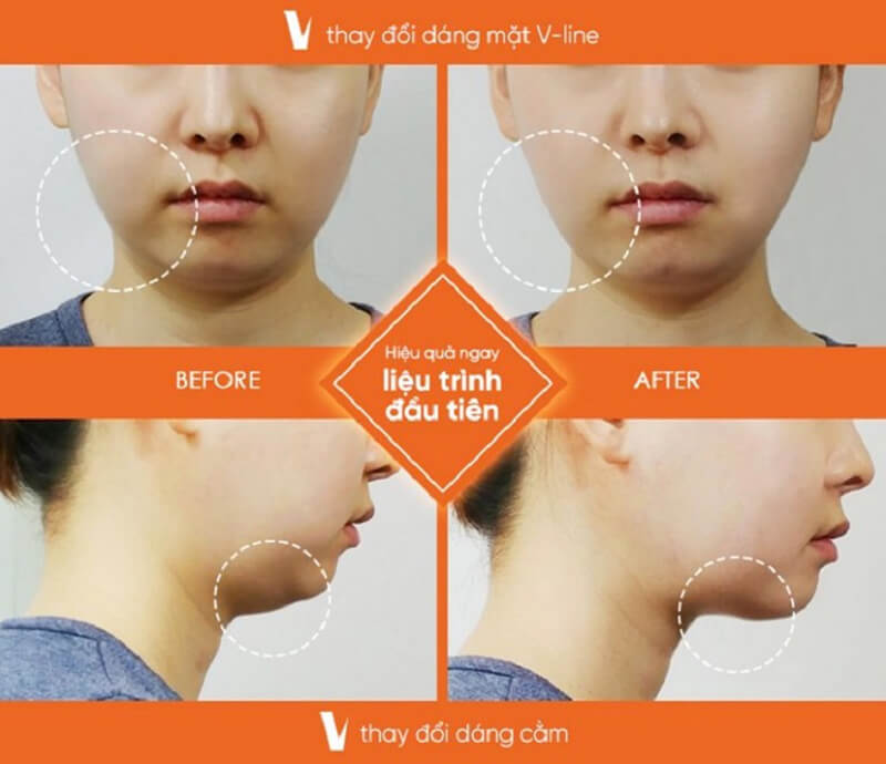 Hiệu quả thay đổi rõ rệt và đường nét trên gương mặt thanh tú hơn