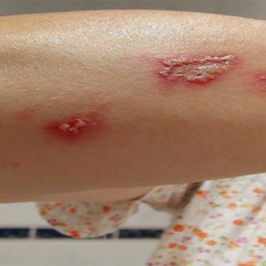 Chữa vết côn trùng cắn bằng những nguyên liệu tự nhiên