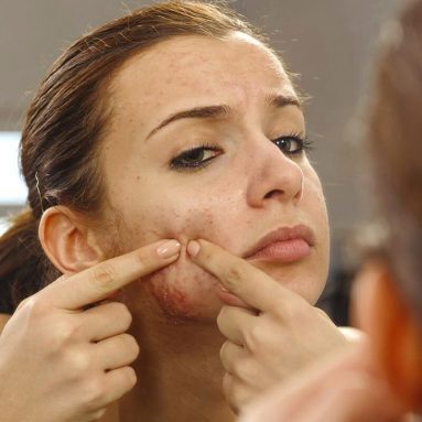 05 Cách trị mụn trứng cá đơn giản nhưng rất hiệu quả